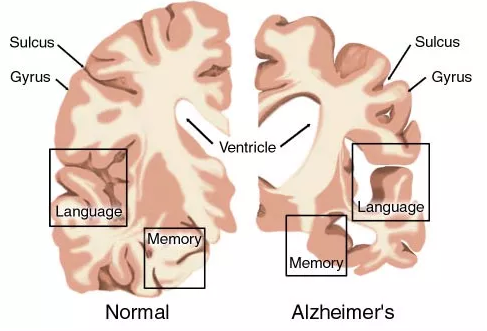 AD药物研发现状：辉瑞、礼来、百健、诺华、强生……