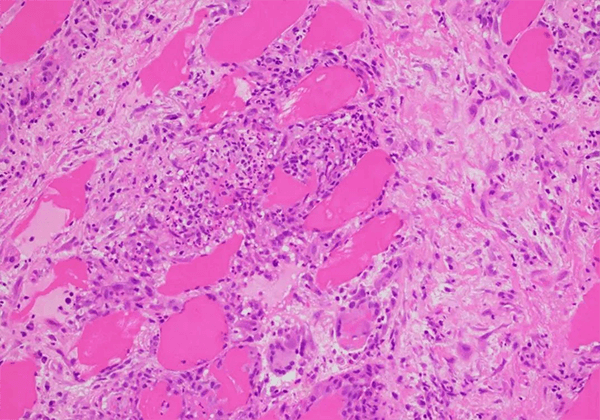 【不朽情缘mg官网助力】治疗结节病的KBMAB-16获FDA批准临床