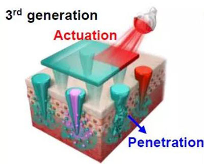 第三代：通过微针介导的皮肤层破坏和微针伴随的各种功能增强药物转运.jpg